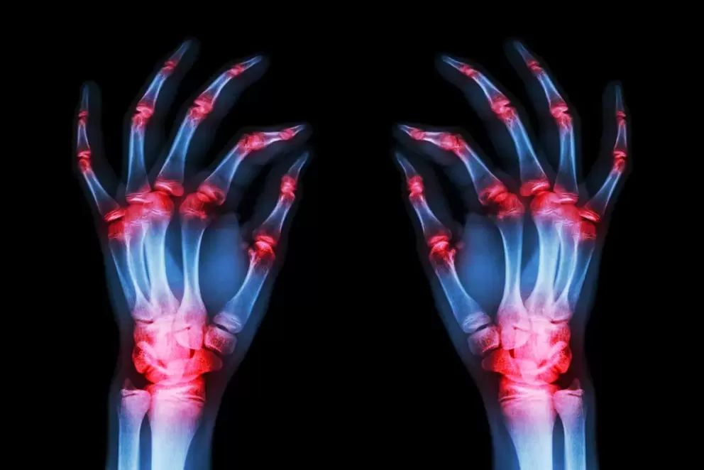 Arthritis of finger joints
