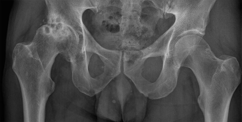 Stage 3 hip arthritis on X-ray