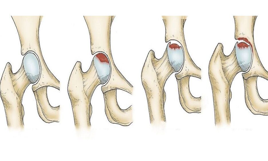 progression of hip pain