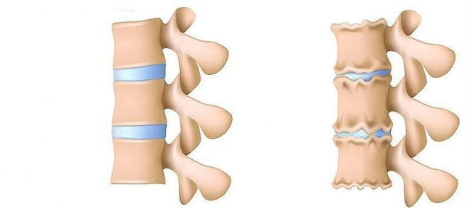 Bone fibrosis from within