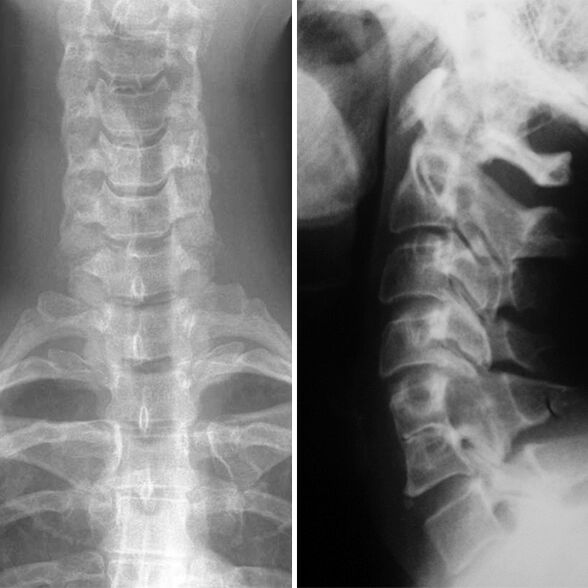 X -ray of the cervical spine