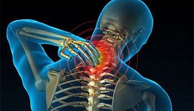 Symptoms of cervical spine osteoarthritis