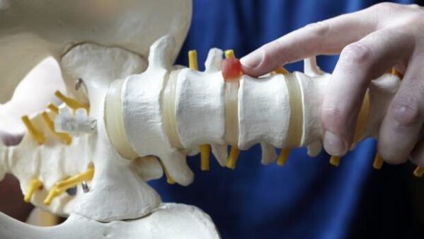Spinal herniation is the cause of lower back pain