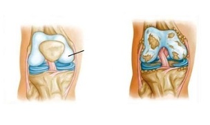 Pathological changes in knee arthritis