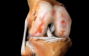 What is knee arthritis
