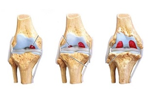 degenerative stage of the knee joint