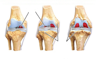 degenerative knee stage