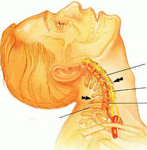 Cervical spine tumors