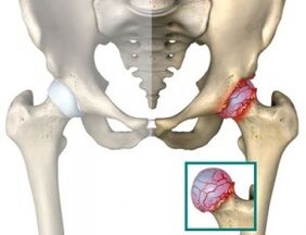 causes atrophy of the hip joints