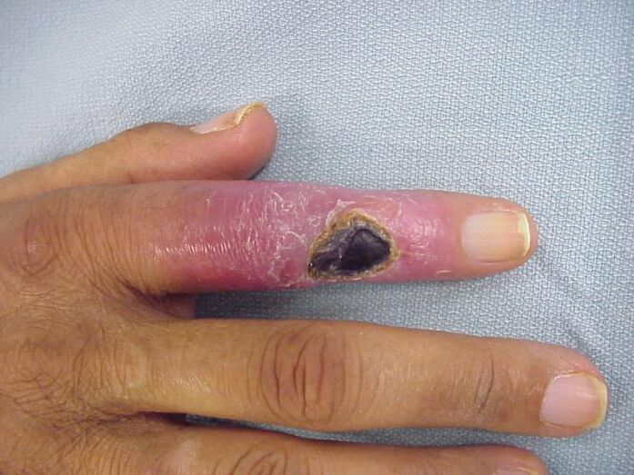 Osteomyelitis is the cause of pain in the finger joints