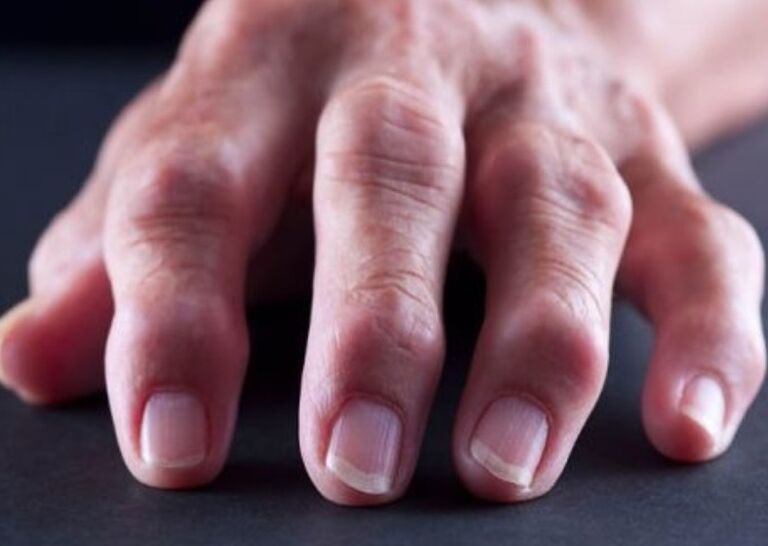 Rheumatoid arthritis is the cause of pain in the joints of the fingers