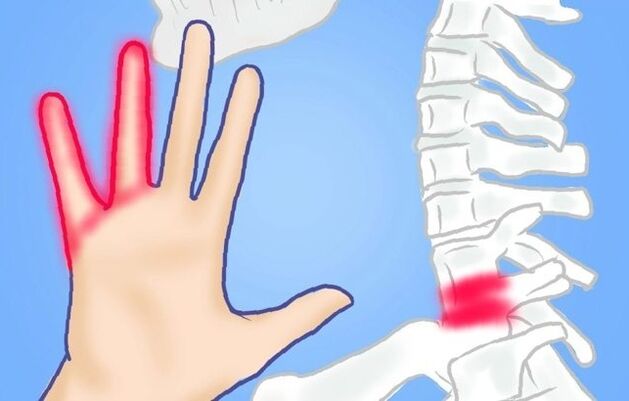 Pinched nerve is the cause of back pain
