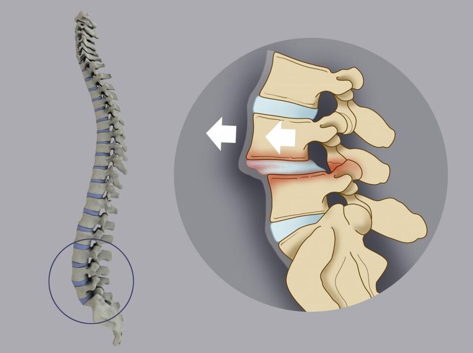 Spondylolisthesis causes back pain