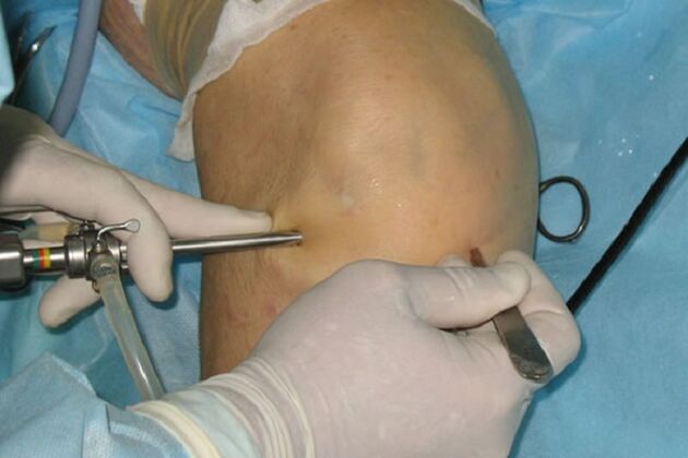 Arthroscopy for knee pain
